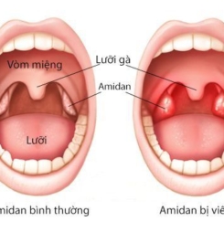 Trẻ bị mắc viêm Amidan không thể chủ quan